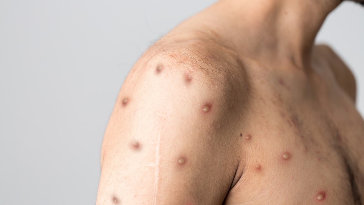 Es muy poco probable que viruela del mono alcance nivel de contagio de COVID: experto de UNAM 