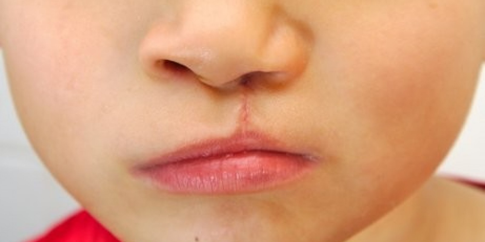 Se detectó medio centenar de casos de labio leporino en Puebla