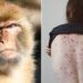 ¿Cuáles son síntomas de la viruela del mono?