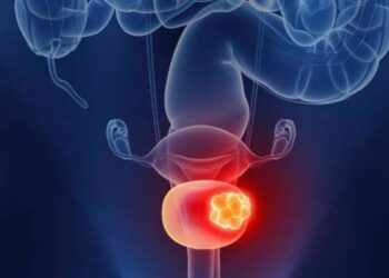 Sangre al orinar, principal síntoma del cáncer de vejiga