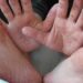 Puebla registra 470 casos probables y 66 brotes de virus coxsackie en escuelas