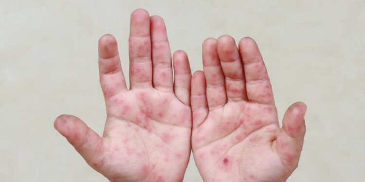 Descarta Secretaría de Salud epidemia de virus Coxsackie en Puebla