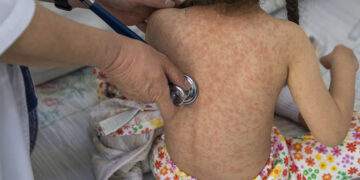 Ante los nuevos brotes de sarampión: ¿solo los niños deben vacunarse?