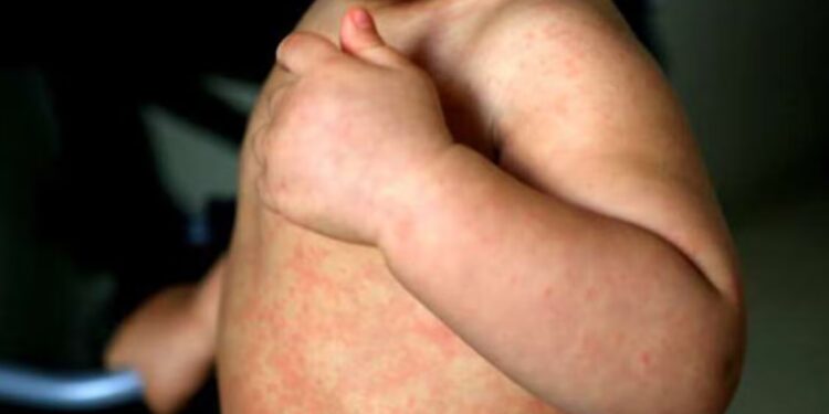 México rebasa los 10 mil casos de sarampión
