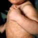 México rebasa los 10 mil casos de sarampión